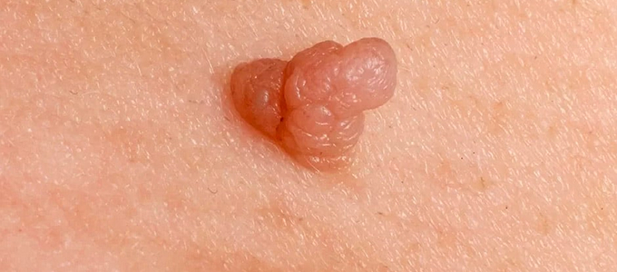Verrugas
